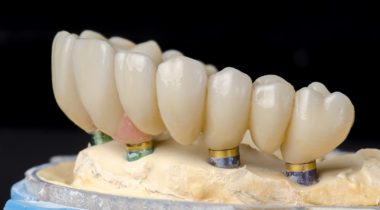 Monolithic zirconia restorations full arch implant supported with the ceramic load in vestibular, back background.